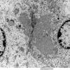 2E4 Ependymoma (Case 2) EM 004 - Copy