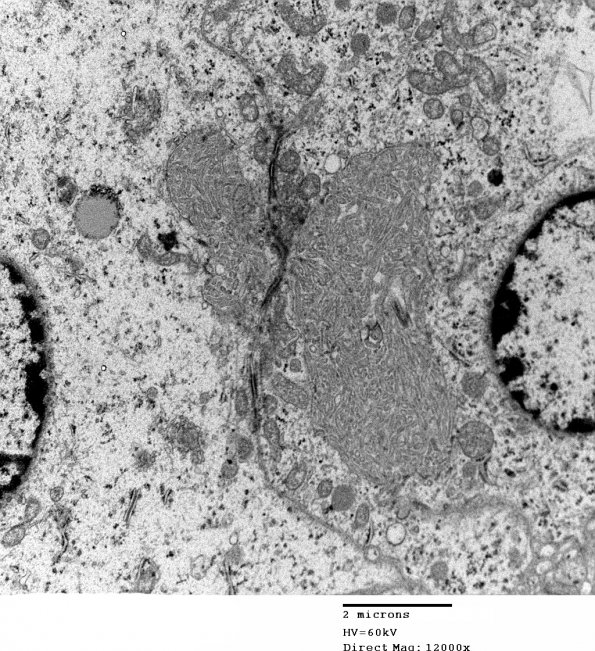 2E4 Ependymoma (Case 2) EM 004 - Copy