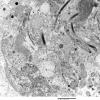 2E7 Ependymoma (Case 2) EM 013 - Copy