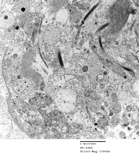 2E7 Ependymoma (Case 2) EM 013 - Copy