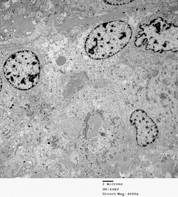 2E8 Ependymoma (Case 2) EM 017 - Copy