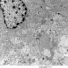 2E9 Ependymoma (Case 2) EM 021 - Copy