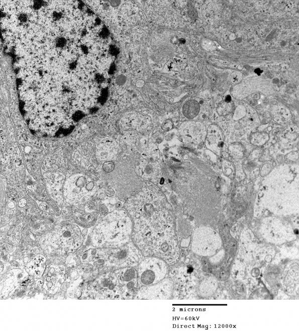 2E9 Ependymoma (Case 2) EM 021 - Copy