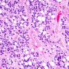 3A1 Ependymoma, anaplastic (Case 3) 2.jpg