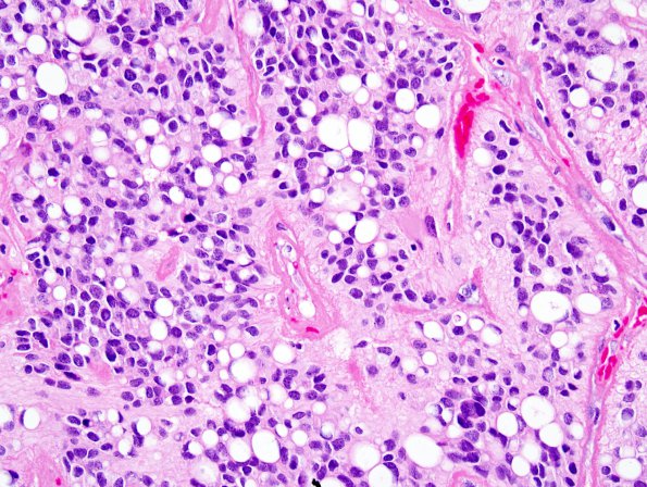 3A1 Ependymoma, anaplastic (Case 3) 2.jpg