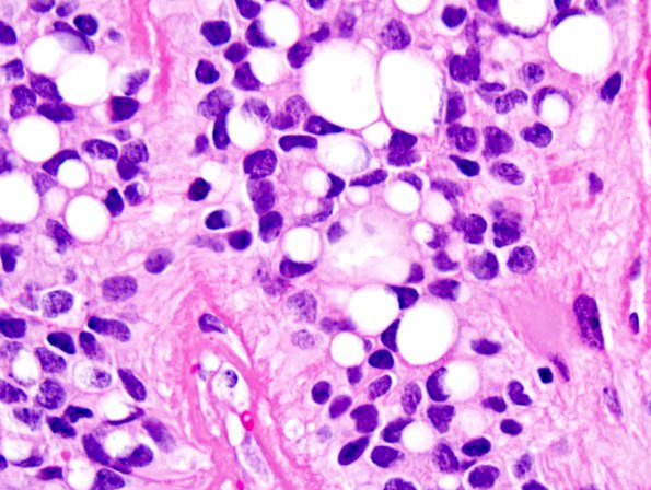 3A2 Ependymoma, anaplastic (Case 3) 3.jpg