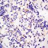 3B1 Ependymoma, anaplastic (Case 3) EMA 1.jpg