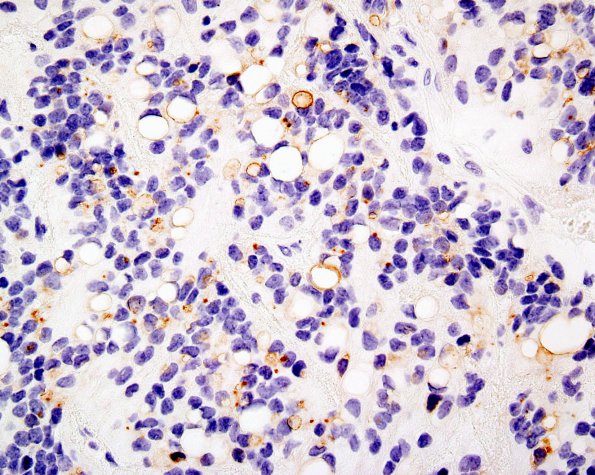 3B1 Ependymoma, anaplastic (Case 3) EMA 1.jpg