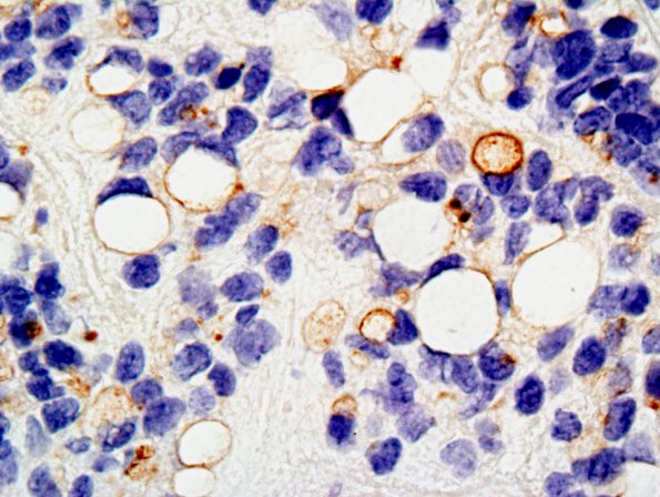 3B2 Ependymoma, anaplastic (Case 3) EMA 2.jpg