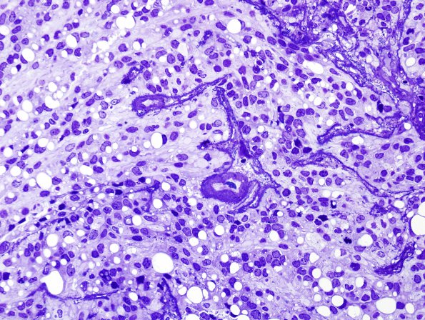 3C1 Ependymoma, anaplastic (Case 3) Plastic 1 (2)