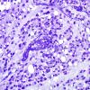 3C2 Ependymoma, anaplastic (Case 3) Plastic 2