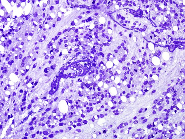 3C2 Ependymoma, anaplastic (Case 3) Plastic 2