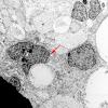 3D1 Ependymoma, anaplastic (Case 3) EM 1 copy - Copy (2)