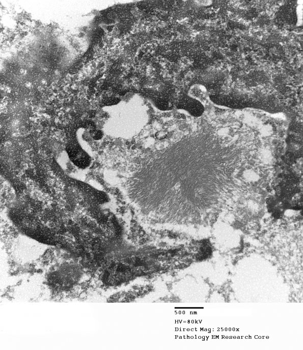 3D5 Case 3 Tumor_003 - Copy