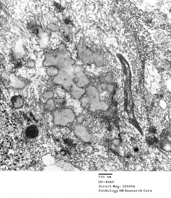 3D6 Case 3 Tumor_009 - Copy