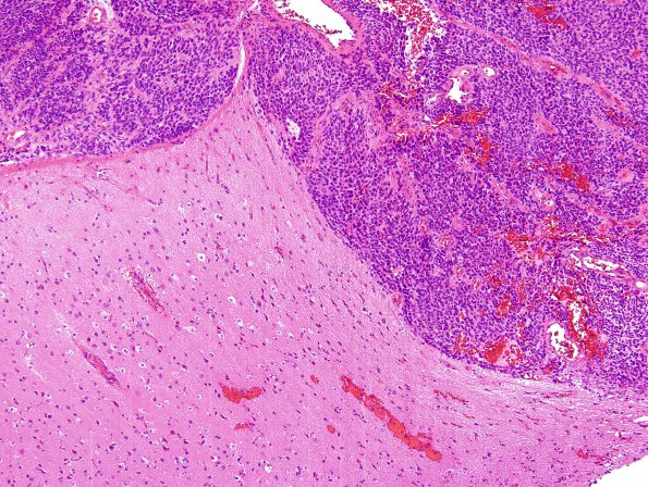 4A1 Ependymoma, anaplastic (Case 4) H&E 7