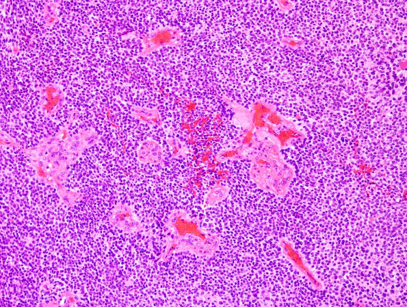 4A2 Ependymoma, anaplastic (Case 4) H&E 3