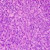 4A3 Ependymoma, anaplastic (Case 4) H&E 4