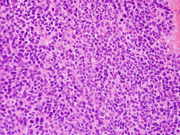 4A3 Ependymoma, anaplastic (Case 4) H&E 4