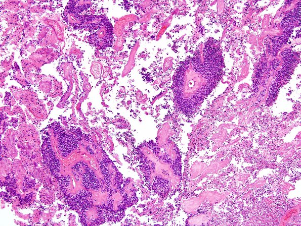 4A4 Ependymoma, anaplastic (Case 4) H&E 6