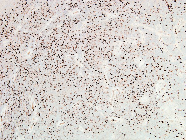 4C Ependymoma, anaplastic (Case 4) Ki67 2