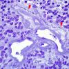 4D1 Ependymoma, anaplastic (Case 4) Plastic 2 copy