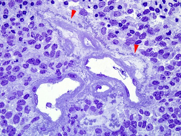 4D1 Ependymoma, anaplastic (Case 4) Plastic 2 copy