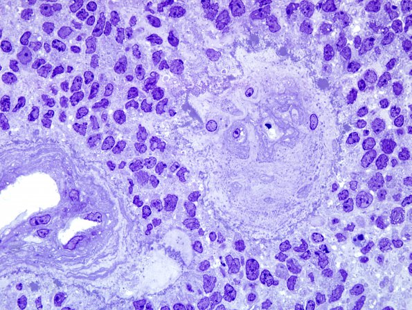 4D4 Ependymoma, anaplastic (Case 4) Plastic 7