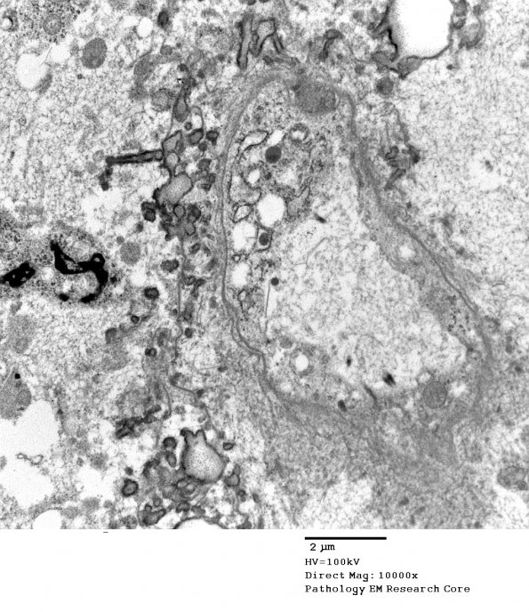 4E1 Ependymoma, anaplastic (Case 4) EM 007 - Copy