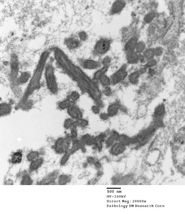 4E10 Ependymoma, anaplastic (Case 4) EM 060 - Copy