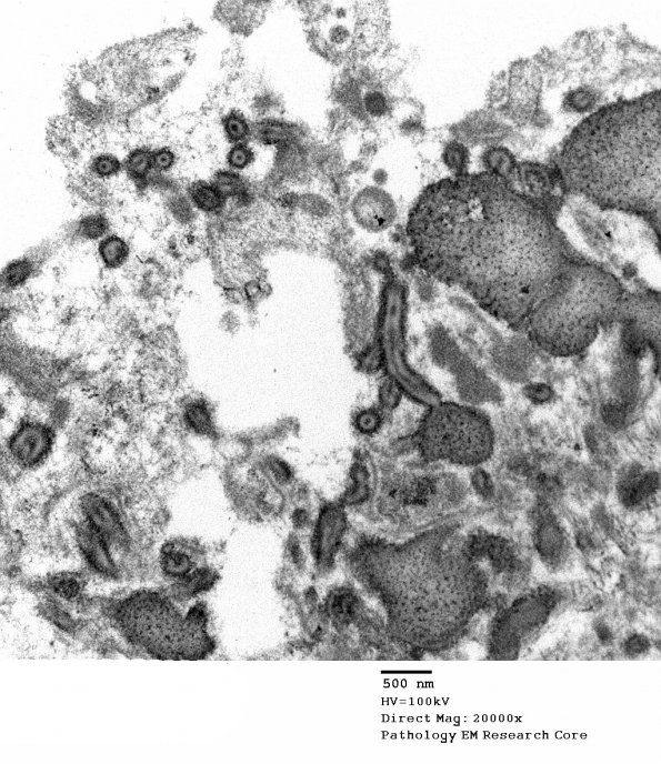 4E11 Ependymoma, anaplastic (Case 4) EM 046 - Copy