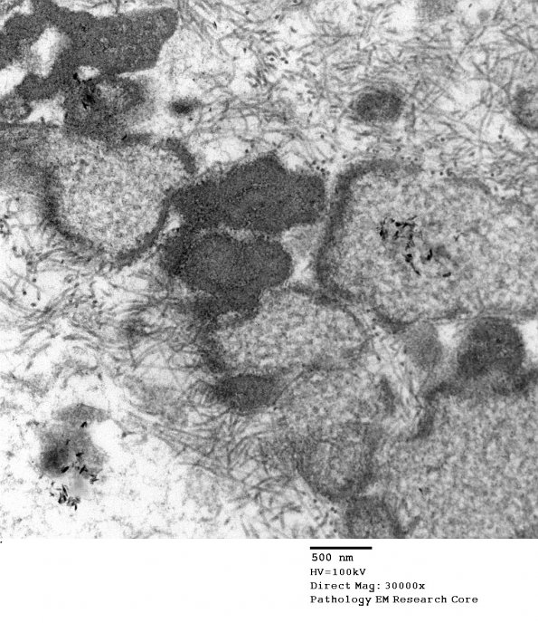 4E4 Ependymoma, anaplastic (Case 4) EM 069 - Copy