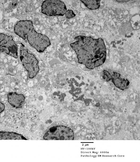 4E5 Ependymoma, anaplastic (Case 4) EM 064 - Copy