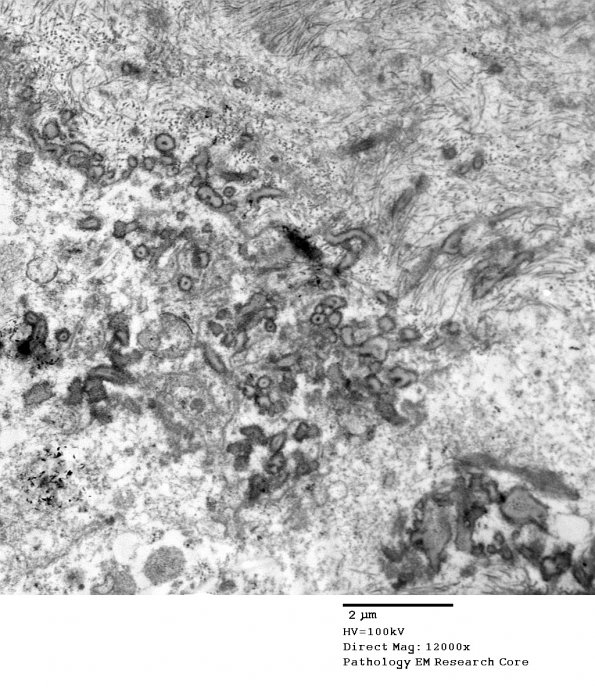 4E6 Ependymoma, anaplastic (Case 4) EM 075 - Copy