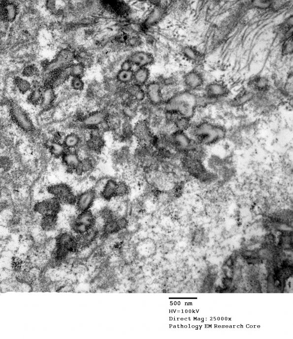 4E7 Ependymoma, anaplastic (Case 4) EM 077 - Copy