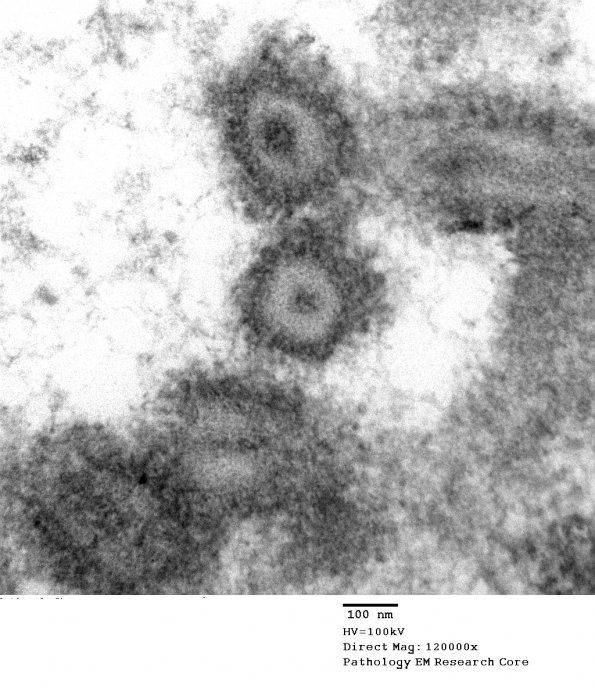 4E8 Ependymoma, anaplastic (Case 4) EM 049 - Copy - Copy