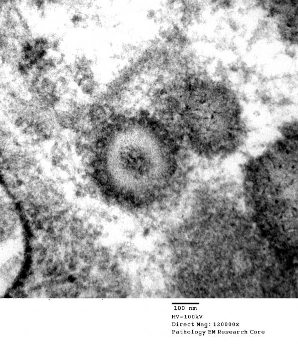 4E9 Ependymoma, anaplastic (Case 4) EM 092 - Copy