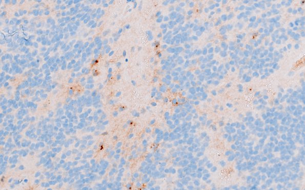 5C Ependymoma, anaplastic, RELA Fusion pos (Case 5) EMA 1