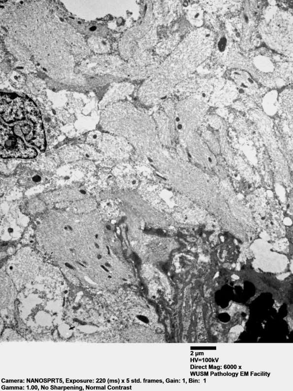 5F1 Ependymoma, anaplastic, RELA Fusion pos (Case 5) EM 002 - Copy