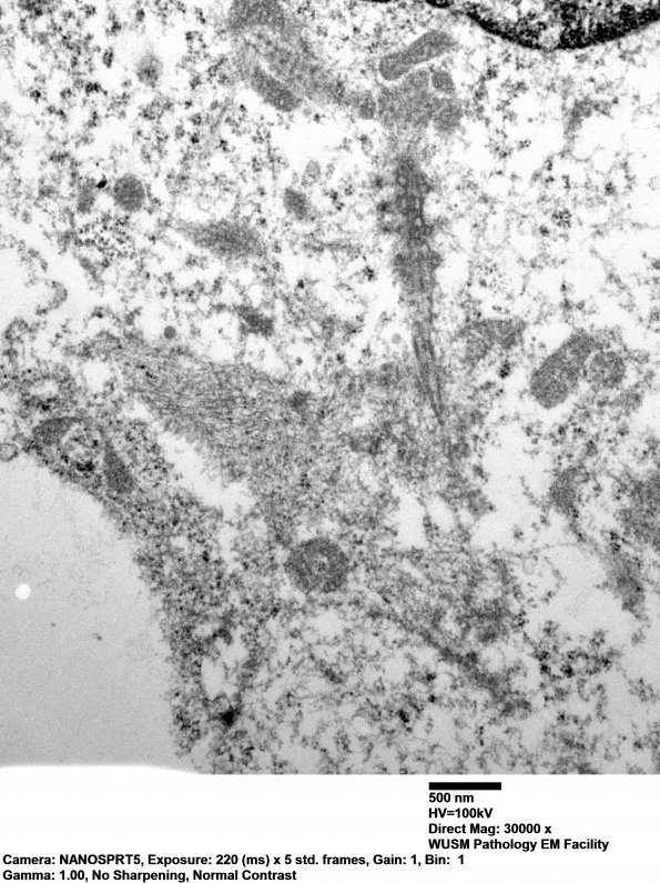 5F13 Ependymoma, anaplastic, RELA Fusion pos (Case 5) EM 026 - Copy