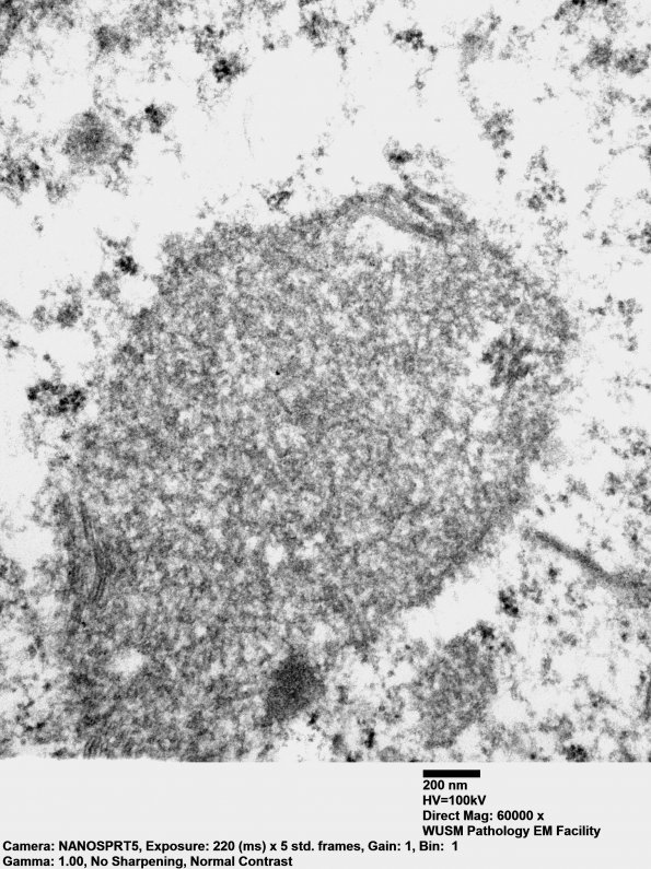 5F3 Ependymoma, anaplastic, RELA Fusion pos (Case 5) EM 031 - Copy