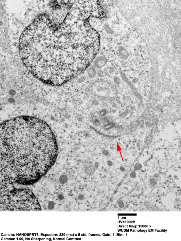 5F8 Ependymoma, anaplastic, RELA Fusion pos (Case 5) EM 018 copy - Copy