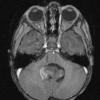 6A1 Ependymoma, focal anaplasia (Case 6) T1W - Copy