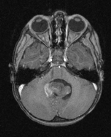 6A1 Ependymoma, focal anaplasia (Case 6) T1W - Copy