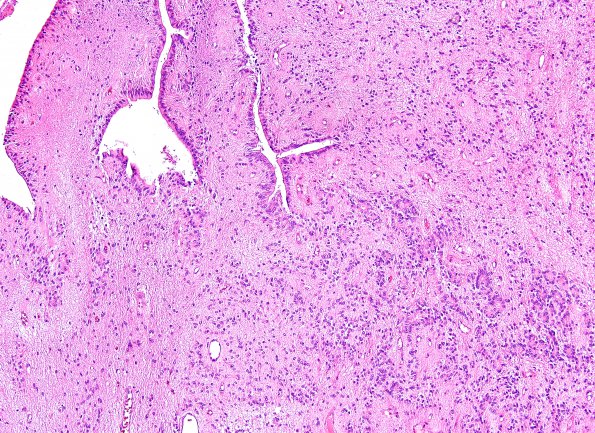 6B1 Ependymoma, focal anaplasia (Case 6) H&E 1