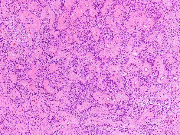 6B2 Ependymoma, focal anaplasia (Case 6) H&E 8