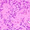 6B3 Ependymoma, focal anaplasia (Case 6) H&E 4