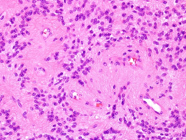 6B3 Ependymoma, focal anaplasia (Case 6) H&E 4