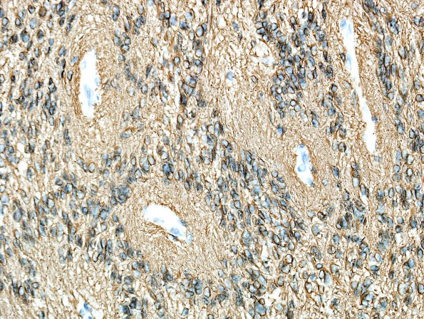 6C1 Ependymoma, focal anaplasia (Case 6) GFAP 9