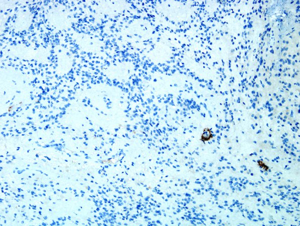 6D1 Ependymoma, focal anaplasia (Case 6) D2-40 11